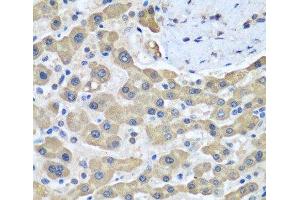 Immunohistochemistry of paraffin-embedded Human liver cancer using GFM1 Polyclonal Antibody at dilution of 1:100 (40x lens). (GFM1 antibody)