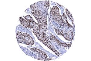 Esophagus Squamous cell carcinoma with strong SOX9 immunostaining of most tumor cells (Recombinant SOX9 antibody  (AA 393-508))