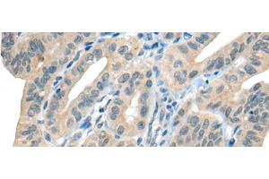 Immunohistochemistry of paraffin-embedded Human thyroid cancer tissue using CHAT Polyclonal Antibody at dilution of 1:30(x200) (Choline Acetyltransferase antibody)