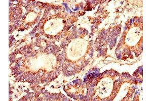 Immunohistochemistry of paraffin-embedded human colon cancer using ABIN7158350 at dilution of 1:100 (LASP1 antibody  (AA 128-252))
