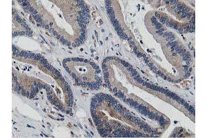 Immunohistochemical staining of paraffin-embedded Adenocarcinoma of Human colon tissue using anti-ATG3 mouse monoclonal antibody.