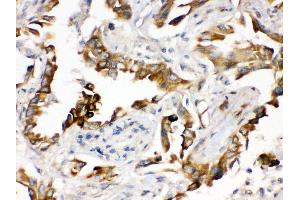 Anti- PGRMC1 Picoband antibody, IHC(P) IHC(P): Human Lung Cancer Tissue