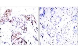 Immunohistochemistry analysis of paraffin-embedded human breast carcinoma, using Elk1 (Phospho-Ser389) Antibody.