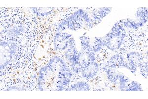 Detection of CALPRO in Human Colorectal cancer Tissue using Polyclonal Antibody to Calprotectin (CALPRO) (S100A8/A9 Complex (Calprotectin) antibody  (AA 1-114))