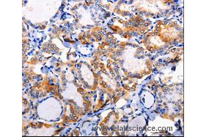Immunohistochemistry of Human liver cancer using AP1B1 Polyclonal Antibody at dilution of 1:100 (AP1B1 antibody)