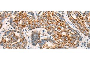 Immunohistochemistry of paraffin-embedded Human liver cancer tissue using CCT8L2 Polyclonal Antibody at dilution of 1:45(x200) (CCT8L2 antibody)