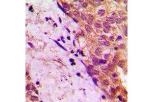 Immunohistochemical analysis of APBB2 staining in human prostate cancer formalin fixed paraffin embedded tissue section. (APBB2 antibody)