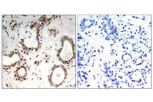Immunohistochemical analysis of paraffin-embedded human breast carcinoma tissue, using HSF1 (Ab-307) antibody (E021206). (HSF1 antibody)