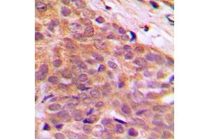 Immunohistochemical analysis of CABLES1 staining in human breast cancer formalin fixed paraffin embedded tissue section. (CABLES1 antibody  (C-Term))