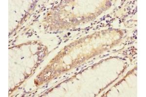 Immunohistochemistry of paraffin-embedded human colon cancer using ABIN7143328 at dilution of 1:100 (ADCY4 antibody  (AA 808-1077))