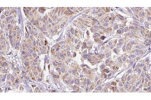 ABIN6277257 at 1/100 staining Human Melanoma tissue by IHC-P. (IL-8 antibody  (Internal Region))