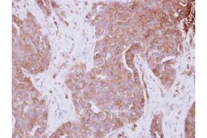 IHC-P Image Immunohistochemical analysis of paraffin-embedded AdCA xenograft, using STAM, antibody at 1:500 dilution.