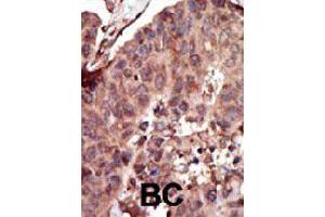Formalin-fixed and paraffin-embedded human cancer tissue reacted with PKLR polyclonal antibody  , which was peroxidase-conjugated to the secondary antibody, followed by AEC staining . (PKLR antibody  (C-Term))