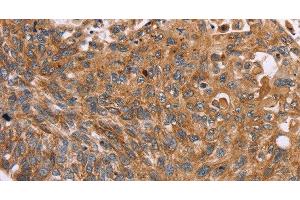 Immunohistochemistry of paraffin-embedded Human esophagus cancer tissue using PMPCB Polyclonal Antibody at dilution 1:50 (PMPCB antibody)