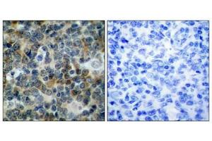 Immunohistochemical analysis of paraffin-embedded human tonsil carcinoma tissue using VASP(Phospho-Ser239) Antibody(left) or the same antibody preincubated with blocking peptide(right). (VASP antibody  (pSer238))
