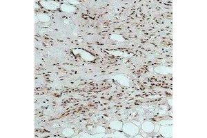 Immunohistochemical analysis of CALHM1 staining in human Hepatocancer formalin fixed paraffin embedded tissue section.
