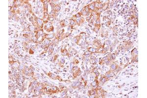 IHC-P Image Lysyl-tRNA synthetase antibody detects KARS protein at cytoplasm on human breast cancer by immunohistochemical analysis. (KARS antibody  (N-Term))