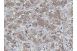 DAB staining on IHC-P; Samples: Human Breast cancer Tissue (HCFC1 antibody  (AA 52-258))