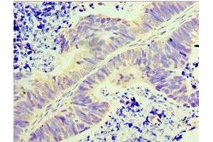 Immunohistochemistry of paraffin-embedded human ovarian cancer using ABIN7154181 at dilution of 1:100 (GLYATL1 antibody  (AA 1-302))