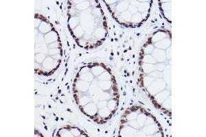Immunohistochemistry of paraffin-embedded human colon carcinoma using MED4 Rabbit mAb (ABIN7268445) at dilution of 1:100 (40x lens).