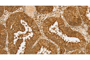 Immunohistochemistry of paraffin-embedded Human cervical cancer tissue using PDP1 Polyclonal Antibody at dilution 1:30 (PDP antibody)