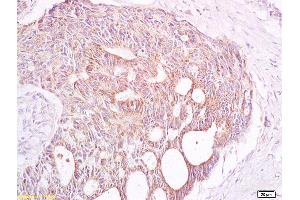 Formalin-fixed and paraffin embedded human rectal carcinoma labeled with Anti TAAL6/Transmembrane 4 L6 family member 1 Polyclonal Antibody, Unconjugated (ABIN716261) at 1:200 followed by conjugation to the secondary antibody and DAB staining (TM4SF1 antibody  (AA 110-202))