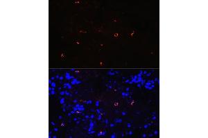 Immunofluorescence analysis of human lung cancer using Lysozyme (LYZ) (LYZ) Rabbit mAb (ABIN7268346) at dilution of 1:100 (40x lens). (LYZ antibody)