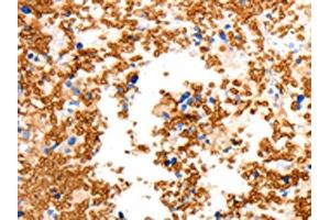 The image on the left is immunohistochemistry of paraffin-embedded Human ovarian cancer tissue using ABIN7192466(SLC2A5 Antibody) at dilution 1/12, on the right is treated with synthetic peptide.