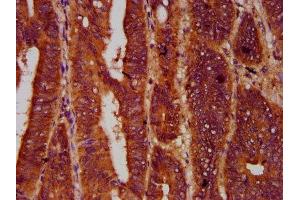 IHC image of ABIN7166132 diluted at 1:600 and staining in paraffin-embedded human colon cancer performed on a Leica BondTM system.