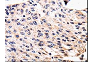 The image is immunohistochemistry of paraffin-embedded Human cervical cancer tissue using (ALK Antibody) at dilution 1/25. (ALK antibody)