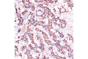 Immunohistochemistry of paraffin-embedded human thyroid cancer using MRPL23 antibody (ABIN7268564) at dilution of 1:100 (40x lens).