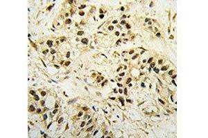 IHC analysis of FFPE human breast carcinoma tissue stained with CDC2 antibody (CDK1 antibody  (AA 1-30))