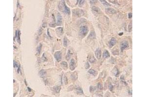 Immunohistochemical staining of formalin-fixed paraffin-embedded human lung carcinoma tissue showing cytoplasmic staining with CASP7 polyclonal antibody  at 1 : 100 dilution. (Caspase 7 antibody  (C-Term))