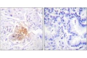 Immunohistochemistry analysis of paraffin-embedded human lung carcinoma tissue, using IL-2R beta/CD122 (Ab-364) Antibody.