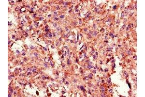 Immunohistochemistry of paraffin-embedded human melanoma using ABIN7172328 at dilution of 1:100 (TANK antibody  (AA 4-98))