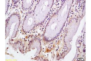 Formalin-fixed and paraffin embedded human gastric carcinoma labeled with Anti-CD72/Ly-32 Polyclonal Antibody, Unconjugated (ABIN741420) at 1:200 followed by conjugation to the secondary antibody and DAB staining (CD72 antibody  (AA 4-110))