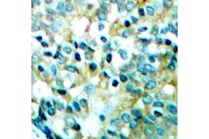 Immunohistochemistry of paraffin-embedded human breast carcinoma tissue, using Phospho-SRC-Y418 antibody (ABIN5969963). (Src antibody  (pTyr418))