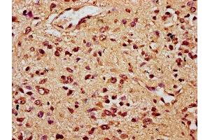 IHC image of ABIN7172459 diluted at 1:300 and staining in paraffin-embedded human glioma performed on a Leica BondTM system. (HNF1B antibody  (AA 539-704))