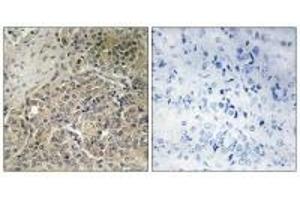 Immunohistochemistry analysis of paraffin-embedded human prostate carcinoma tissue using A26C2/3 antibody. (POTEG antibody)