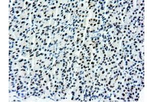 Immunohistochemical staining of paraffin-embedded Carcinoma of Human kidney tissue using anti-NT5DC1 mouse monoclonal antibody. (NT5DC1 antibody)