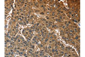 The image on the left is immunohistochemistry of paraffin-embedded Human liver cancer tissue using ABIN7128585(ATP1B2 Antibody) at dilution 1/30, on the right is treated with fusion protein.