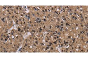 Immunohistochemistry of paraffin-embedded Human liver cancer using CSNK2A1 Polyclonal Antibody at dilution of 1:30 (CSNK2A1/CK II alpha antibody)