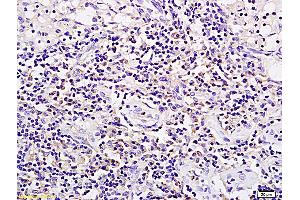 Formalin-fixed and paraffin embedded rat xenograft tumor tissue labeled with Anti SPP24/SPP2 Polyclonal Antibody, Unconjugated (ABIN1385317) followed by conjugation to the secondary antibody and DAB staining (SPP2 antibody  (AA 55-160))