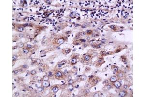 Formalin-fixed and paraffin embedded human liver carcinoma labeled with Anti-MRP2 Polyclonal Antibody, Unconjugated  at 1:200 followed by conjugation to the secondary antibody and DAB staining. (ABCC2 antibody  (AA 485-615))