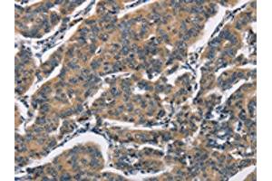 The image on the left is immunohistochemistry of paraffin-embedded Human breast cancer tissue using ABIN7192349(SH2B2 Antibody) at dilution 1/30, on the right is treated with synthetic peptide. (SH2B2 antibody)