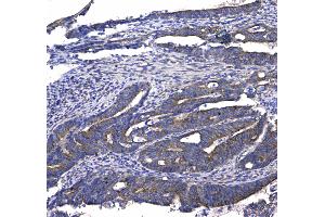 IHC analysis of GSTM3 using anti-GSTM3 antibody . (GSTM3 antibody  (AA 93-206))