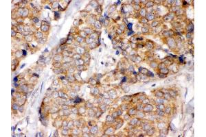 Anti- eIF4A2 Picoband antibody, IHC(P) IHC(P): Human Mammary Cancer Tissue (EIF4A2 antibody  (N-Term))