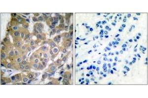 Immunohistochemistry analysis of paraffin-embedded human breast carcinoma tissue, using Cox2 Antibody. (COX2 antibody  (AA 555-604))