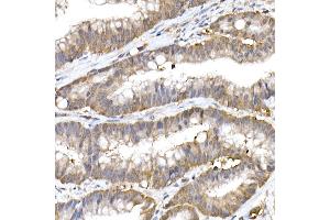 Immunohistochemistry of paraffin-embedded human colon carcinoma using Ube2L3 / UBCH7 Rabbit mAb (ABIN7271178) at dilution of 1:25 (40x lens). (UBE2L3 antibody)