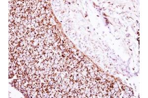 IHC-P Image Immunohistochemical analysis of paraffin-embedded human breast cancer, using Glutamate Dehydrogenase, antibody at 1:250 dilution. (GLUD1 antibody)